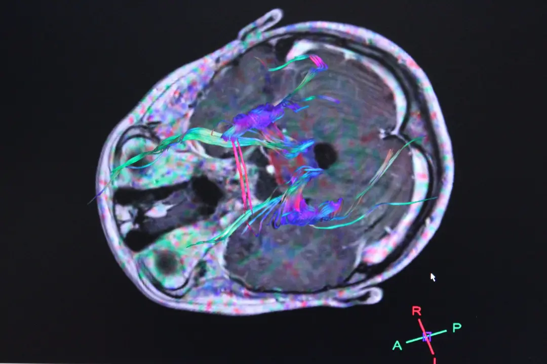 EuropaPress_1351368_radiografias_electroencefalogramas_actividad_cerebro_tumor_tumores