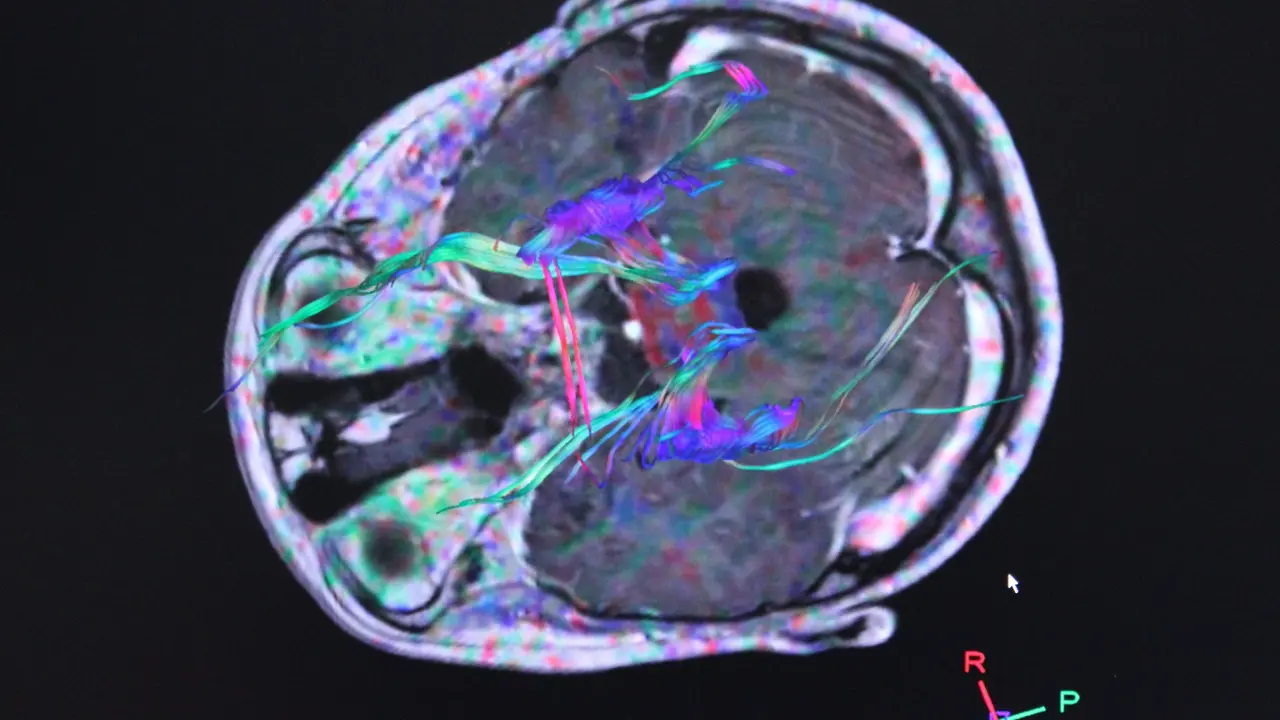 EuropaPress_1351368_radiografias_electroencefalogramas_actividad_cerebro_tumor_tumores